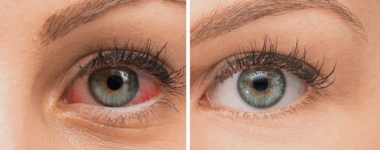 Exploring Dry Eye Clinical Trials: Could You Be a Candidate?